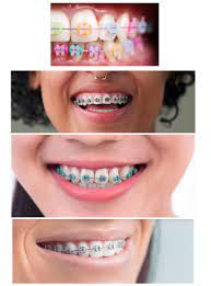 best colors to get for braces