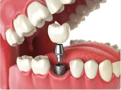 Best Dental Implants In India