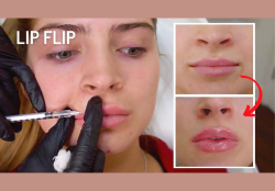 Lip Flip Before and After