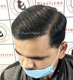 Best Hair Transplant in lucknow – Plasticos Clinic