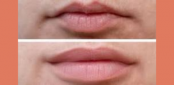 Title: “Lip Flip Magic: Before and After Transformations”