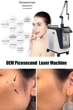 OEM picosecond laser machine. CE certification picosecond laser tattoo removal machine. China pi ...