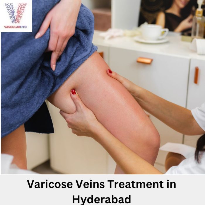 Varicose Veins Treatment in Hyderabad | Vascularhyd