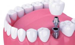 When to Consider Dental Implants: Exploring Options for Tooth Replacement