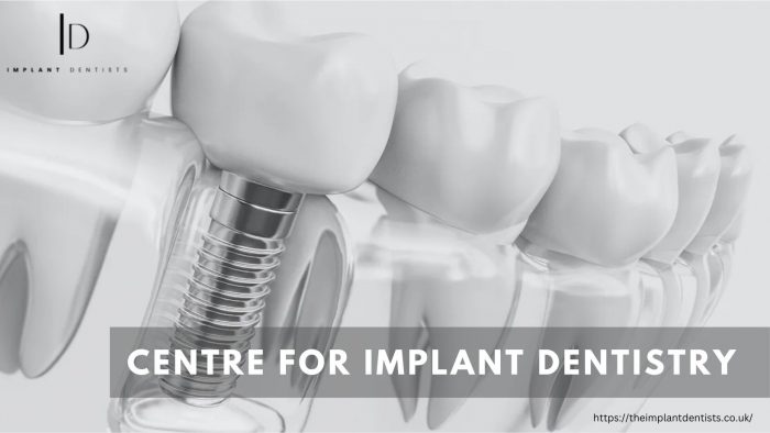 Transforming Smiles, Restoring Confidence|Your Guide to Implant Dentistry