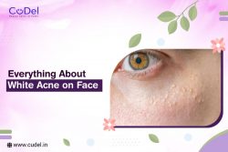 Everything About White Acne on the Face