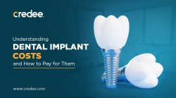 How Much Do Dental Implants Cost? ( in 2024 ) | Credee