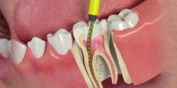 Root Canal Treatment Cost in India