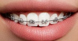what are power chains for braces