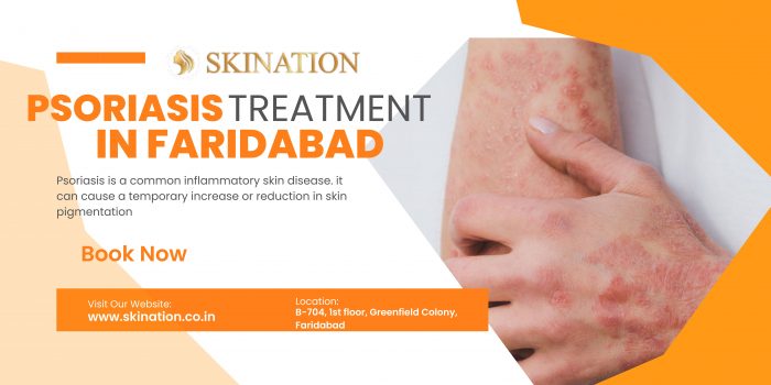 Psoriasis Treatment in Faridabad