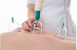 Cupping in physiotherapy