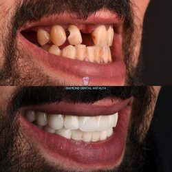 Dental Crowns Turkey
