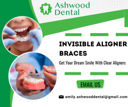 Clear Aligners for Perfect Smile