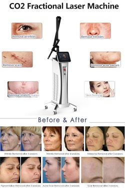 The benefits of CO2 fractional laser procedure compared to other treatment