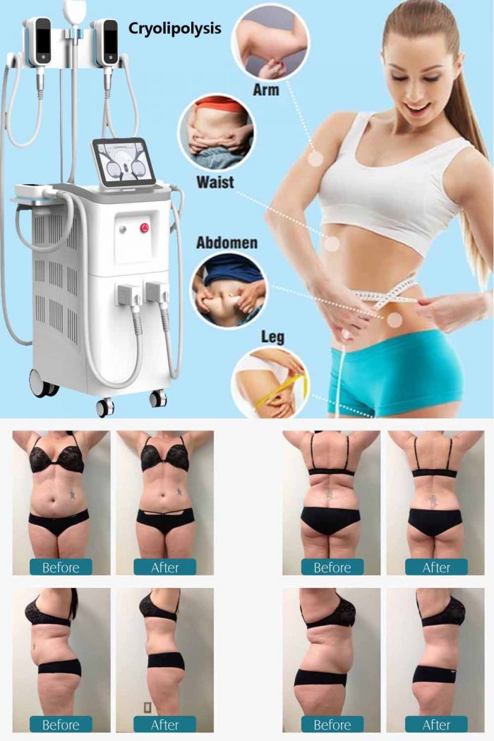 What areas of the body can be treated with cryolipolysis machine?