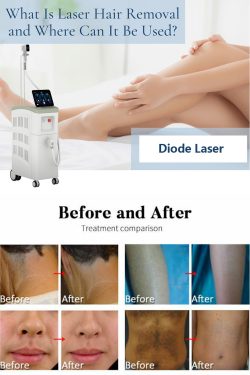 How many sessions need for permanent laser hair removal results