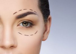 Life-Changing Upper Eyelid Surgery Before and After Journeys