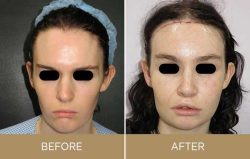 Facial Feminization Surgery Before and After