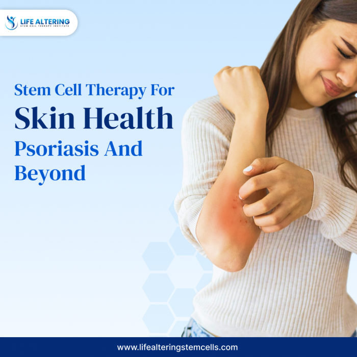 Stem Cell Therapy For Psoriasis