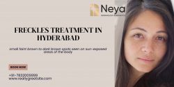 Freckles Treatment in Hyderabad