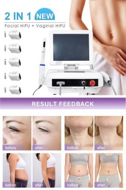 What are some side effects of HIFU vaginal tightening machine?