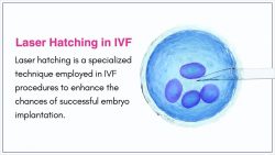 Laser Hatching in IVF