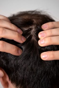 Gentle and Safe: The Top Natural Lice Treatments You Can Trust