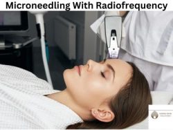 Revitalize Your Skin: Microneedling With Radiofrequency Treatments