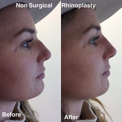 Richmond Cosmetic & Laser offers Non-Surgical Nose Augmentation in Richmond