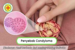 Penyebab Condyloma, Apa yang Perlu Anda Ketahui?
