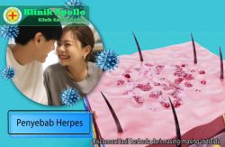 Memahami Penyebab Herpes dan Asal Usul Infeksi yang Umum