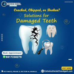 Comprehensive Root Canal Treatment in Mohali at Esthetica Dental Clinic
