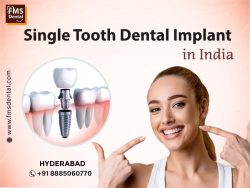 Single Tooth Dental Implant in Hyderabad | Get the best cost of Single tooth implant in Hyderaba ...