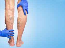 Dubai’s Best: Bid Farewell to Unwanted Spider Veins