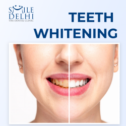 Teeth Whitening Cost In India