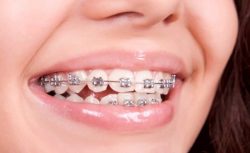 what to eat with braces the first week