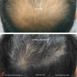 Best Hair Treatment For Receding Hairline