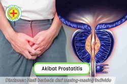 Bukan Masalah Kesehatan Biasa, Kenali 5 Akibat Prostatitis Pria