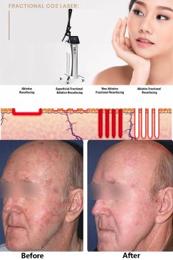 CO2 laser skin resurfacing for acne scars & aging skin