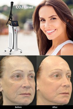 CO2 Fractional Laser For Anti-Aging