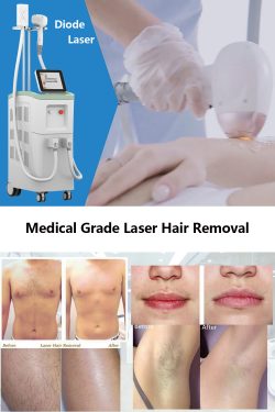 The best results of laser hair removal treatment