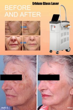How long does it take to see results from erbium laser?