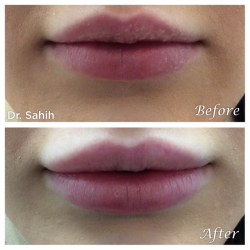 Non-Surgical Lips Augmentation in Richmond by Richmond Cosmetic & Laser