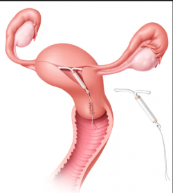 Uterus polyps Toronto