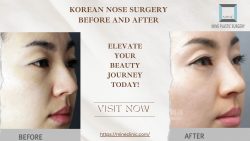 Korean Nose Surgery Before and After