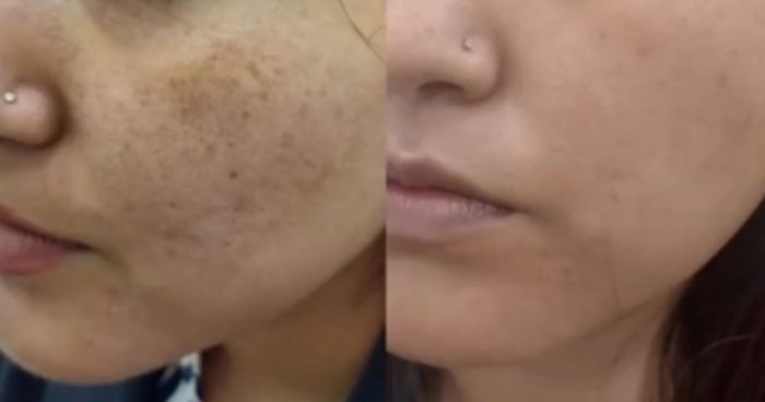 Best Skin Treatment in Kolkata | Image Clinic