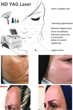 What the Q-switched ND YAG Laser Treats