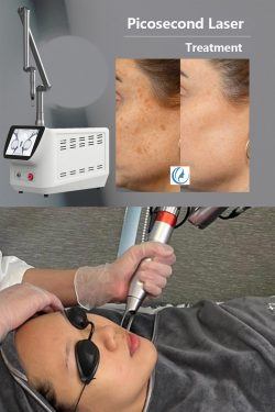 3 Major Things To Know About The Picosecond Laser Treatment Process
