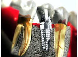 Transform Your Smile with Dental Implants: Esthetica Dental Clinic Mohali, Your Premier Destinat ...
