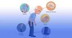 Parkinson’s Disease Stem Cell Treatment
